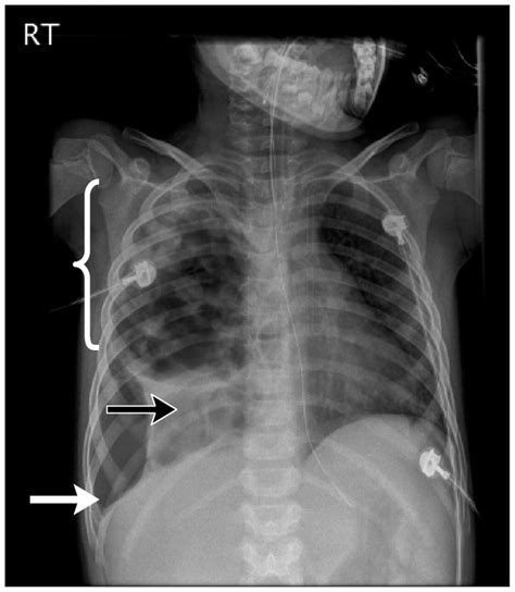 Splenomegaly In Uncomplicated Pneumonia In Thermally Injured 